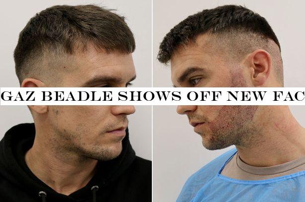 Gaz Beadle shows off new facial hair as he admits he got a beard transplant