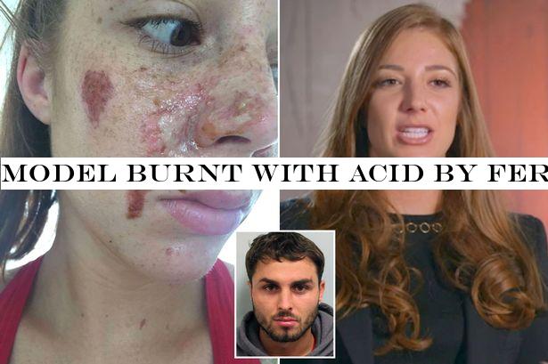 Model burnt with acid by Ferne McCann's ex leaves First Dates viewers emotional