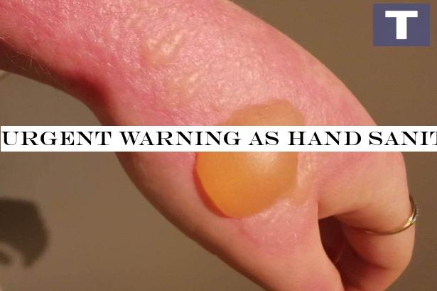Urgent warning as hand sanitiser can cause burns and blisters in strong sunlight